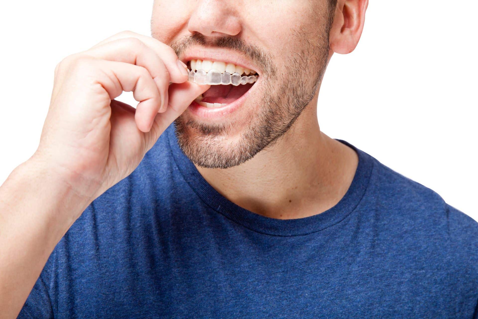 How Long Does Invisalign Take to Straighten Teeth? River City Orthodontics in Glen Allen, VA