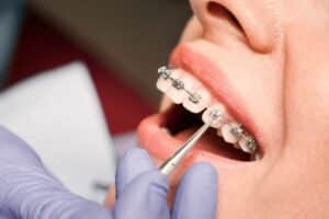 How Often Will I Need Orthodontist Visits During Treatment? River City Orthodontics in Glen Allen, VA.