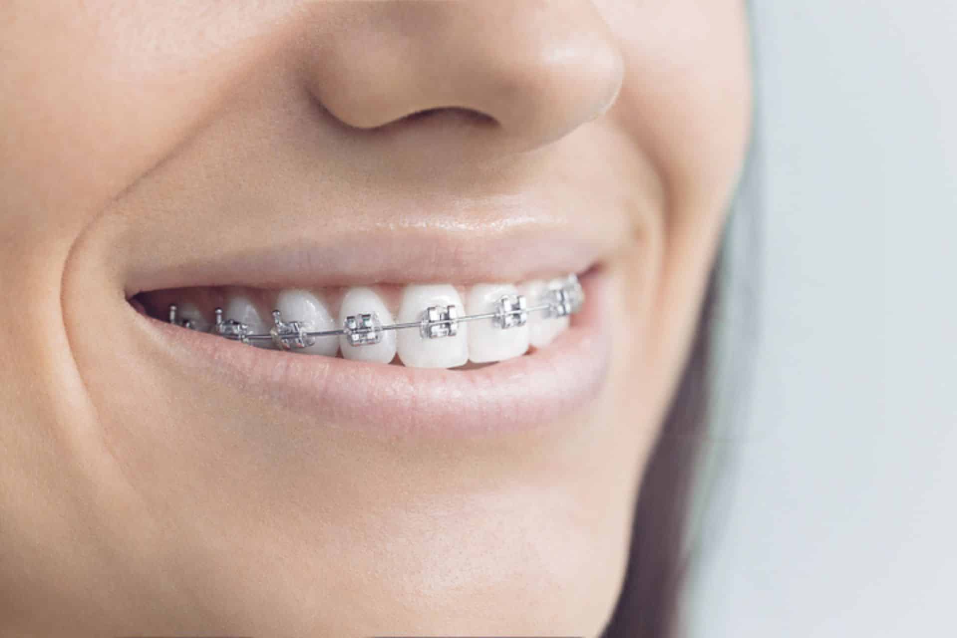 What Are the 10 Common Causes of White Spots After Braces? River City Orthodontics in Glen Allen, VA
