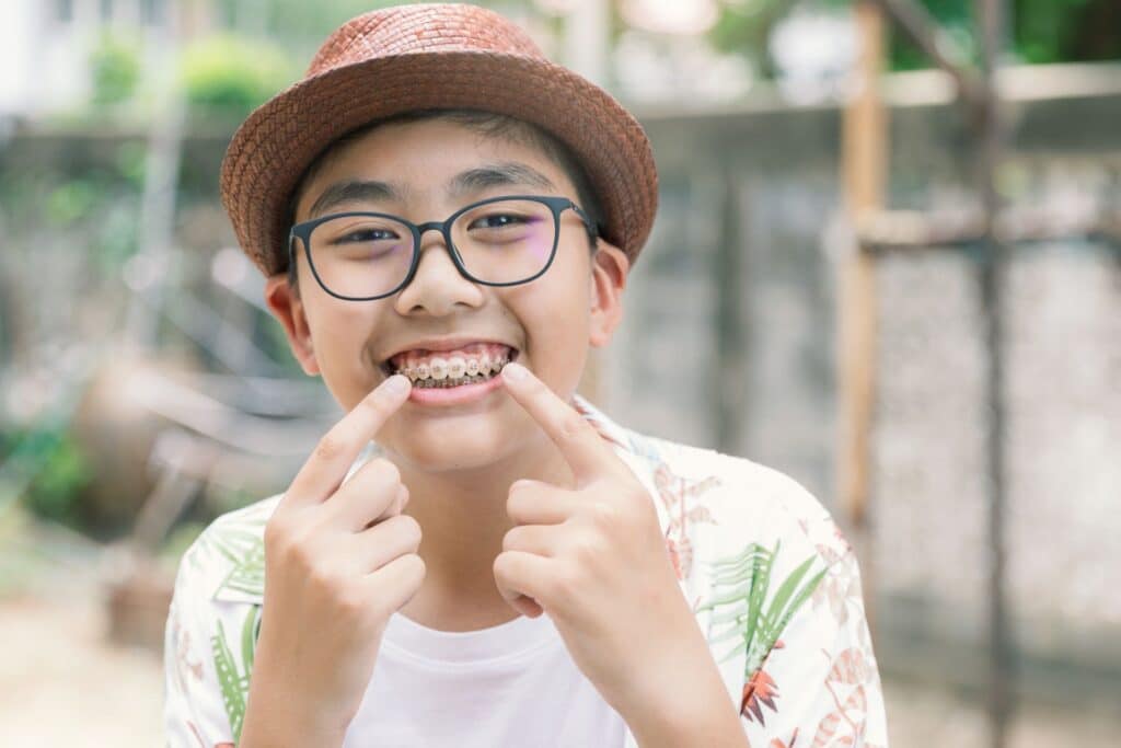 Can Braces Correct a Teen Underbite in Glen Allen, VA? River City Orthodontics